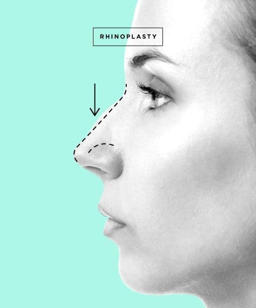 Rhinoplasty in Turkey: Russian Patients Guide 2026